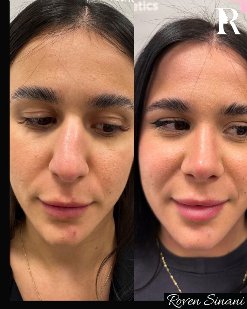 Piezo Rhinoplasty