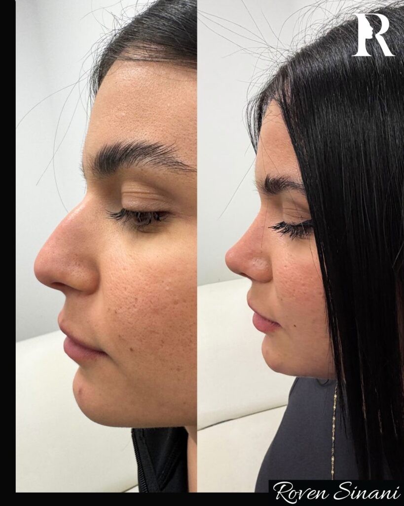 Piezo Rhinoplasty