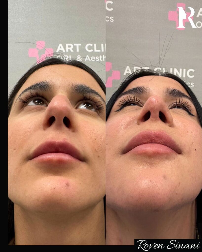 Piezo Rhinoplasty
