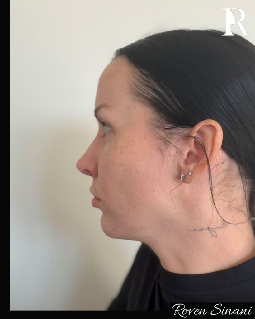 Rhinoplasty