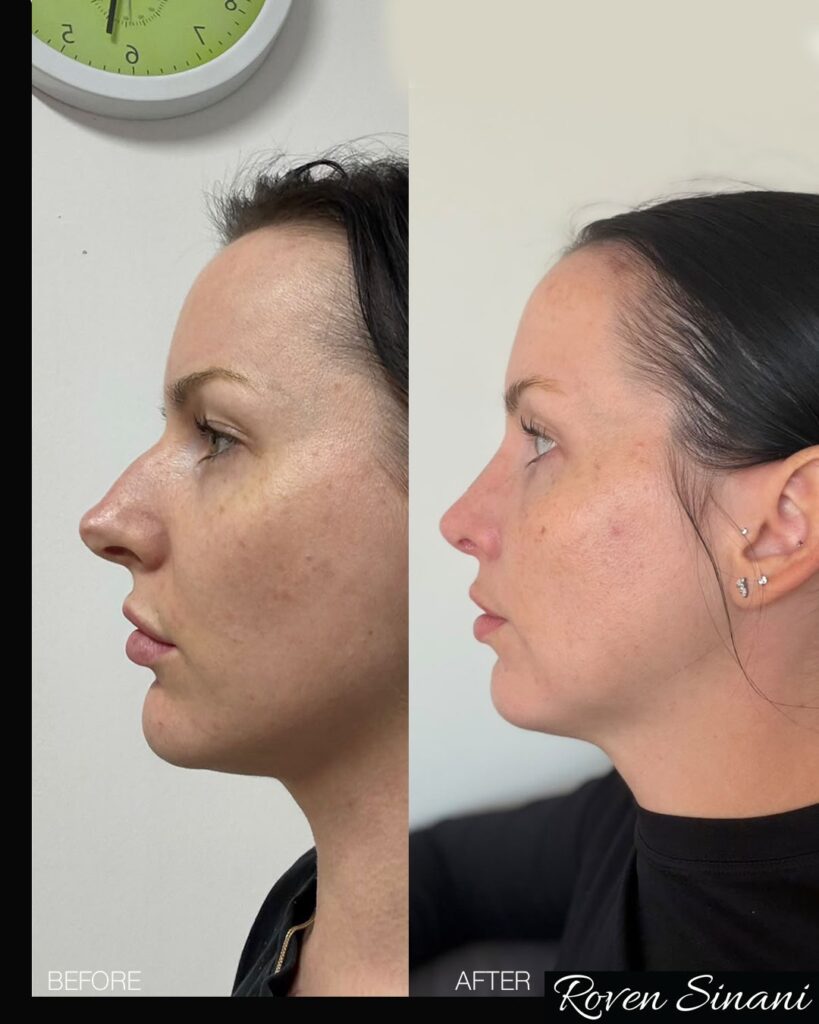 Rhinoplasty