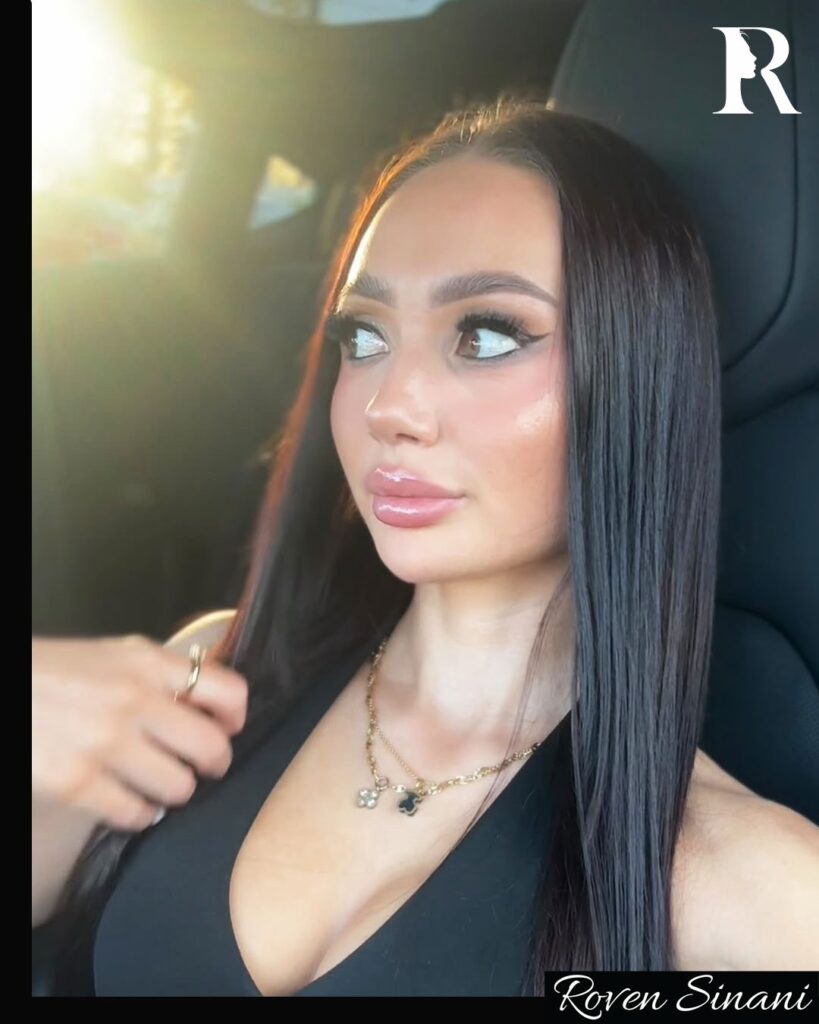 Rhinoplasty