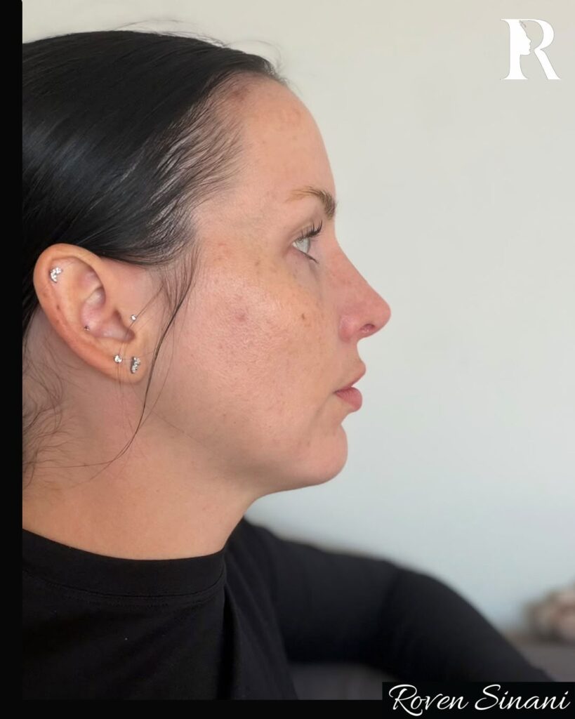 Rhinoplasty